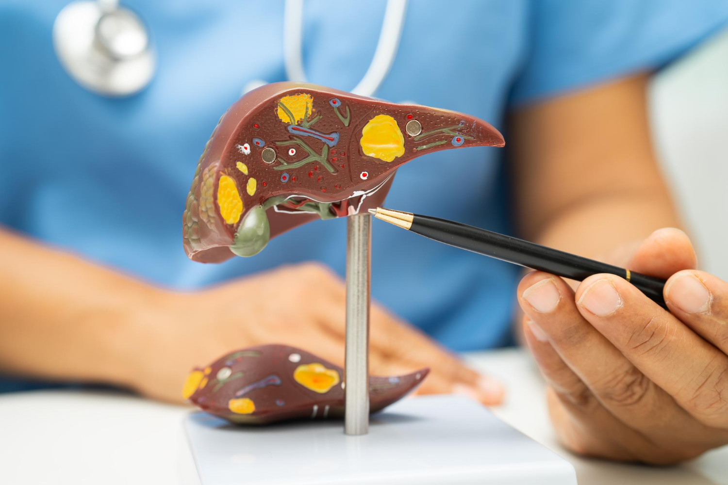 Fatty Liver Disease (Steatotic Liver Disease): Symptoms, Causes, Stages and How to Reverse It Naturally